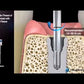 Dental Implant Screw Removal Kit, OSR-KIT
